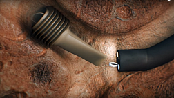 Бронхоблокатор! Бронхоблокаторы  эндоскопия